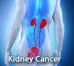 Kidney Cancer